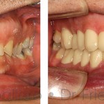 Desgastes dentales, cuando es necesaria la reconstrucción