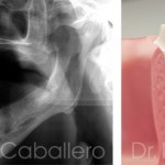 Implantes con poco hueso (1)