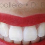 ¿Cómo conseguir unos dientes más blancos?