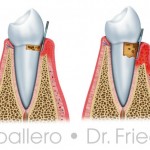 Enfermedad de las encías o periodontitis