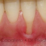 Pérdida de encía o recesión gingival