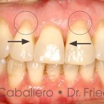 Carillas estéticas para la recesión gingival