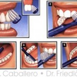 La higiene bucal en las recesiones gingivales