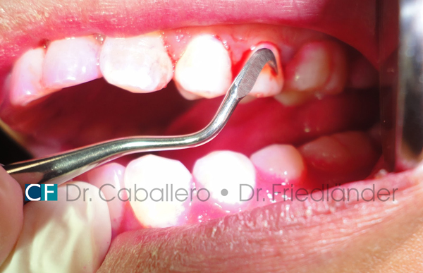 curetaje_clinica-dental-CF-Barcelona