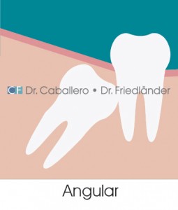 las-muelas-del-juicio_angular-clinica-CF-Barcelona-255x300