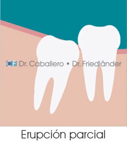 las-muelas-del-juicio_erupcion-parcial-clinica-CF-Barcelona-257x300