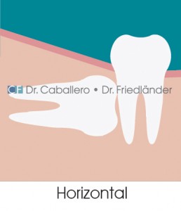 las-muelas-del-juicio_horizontal-clinica-CF-Barcelona-258x300