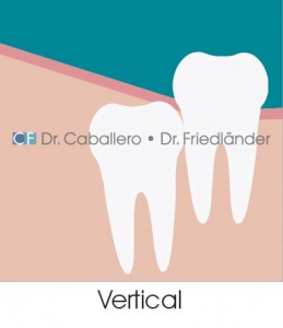 las-muelas-del-juicio_vertical-clinica-CF-Barcelona-259x300