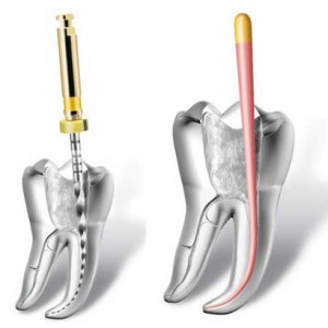 endodoncia