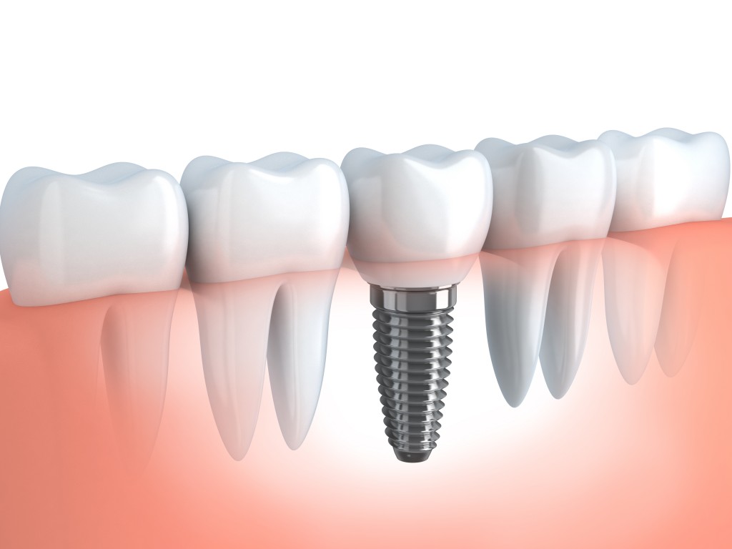 implantes-dentales-barcelona