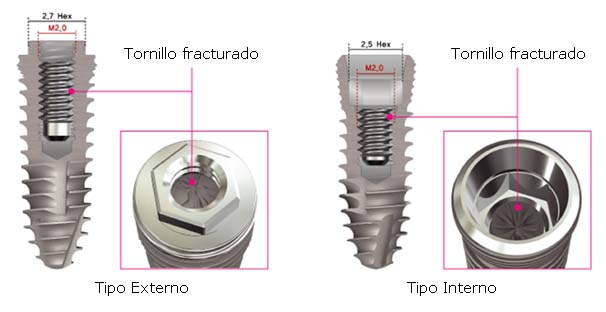 diferencias-implantes-externos-internos