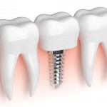 Alternativas de sustitución ante la pérdida dental