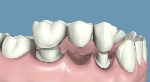 colocación de un puente en perdida dental