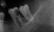 perdida-dental