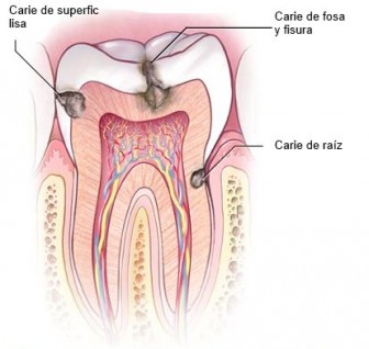 caries-en-dientes-muelas