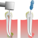 ¿Qué es y cómo se realiza una Endodoncia?