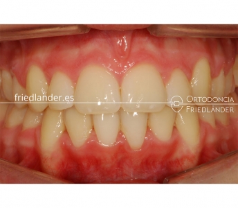 Tratamiento de 18 meses con aparato de Herbst y brackets de autoligado