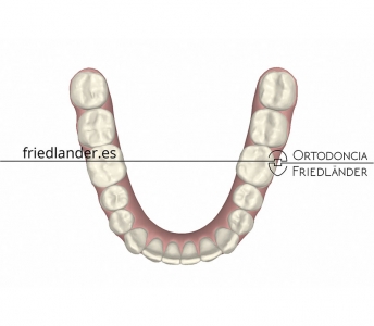 Tratamiento de 12 meses con Invisalign® de apiñamiento severo inferior