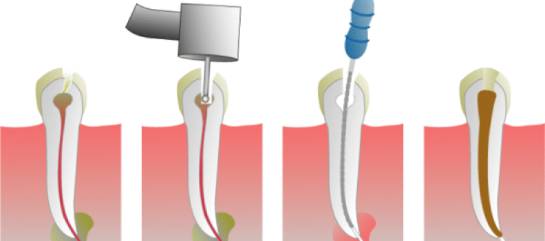 ¿Qué es y cómo se realiza una Endodoncia?