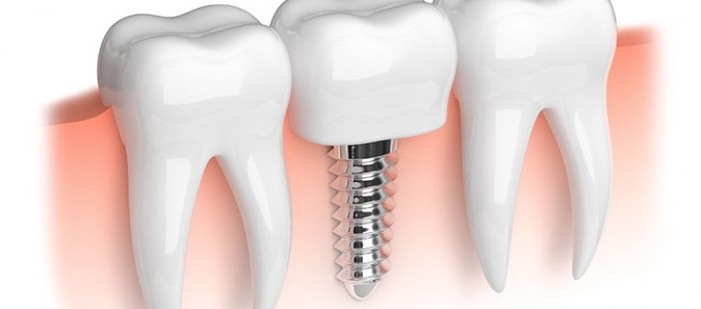 Alternativas de sustitución ante la pérdida dental