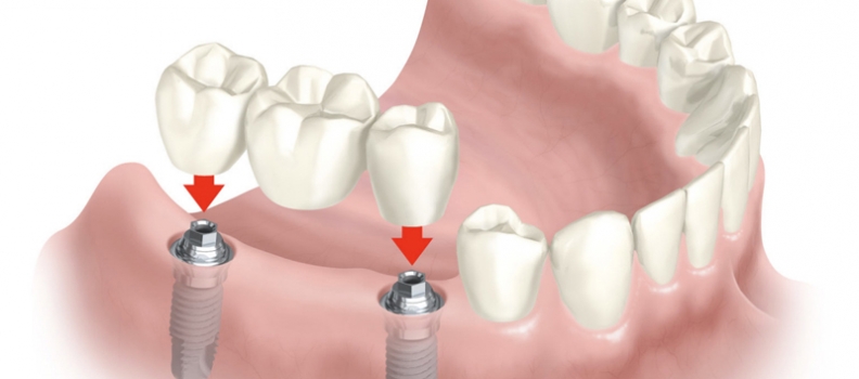 ¿Son los implantes dentales para toda la vida?