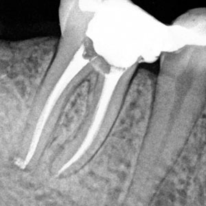 endodoncia tratamiento