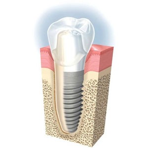 implantes dentales