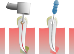 ¿Qué es y cómo se realiza una Endodoncia?